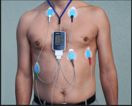 holter monitoring